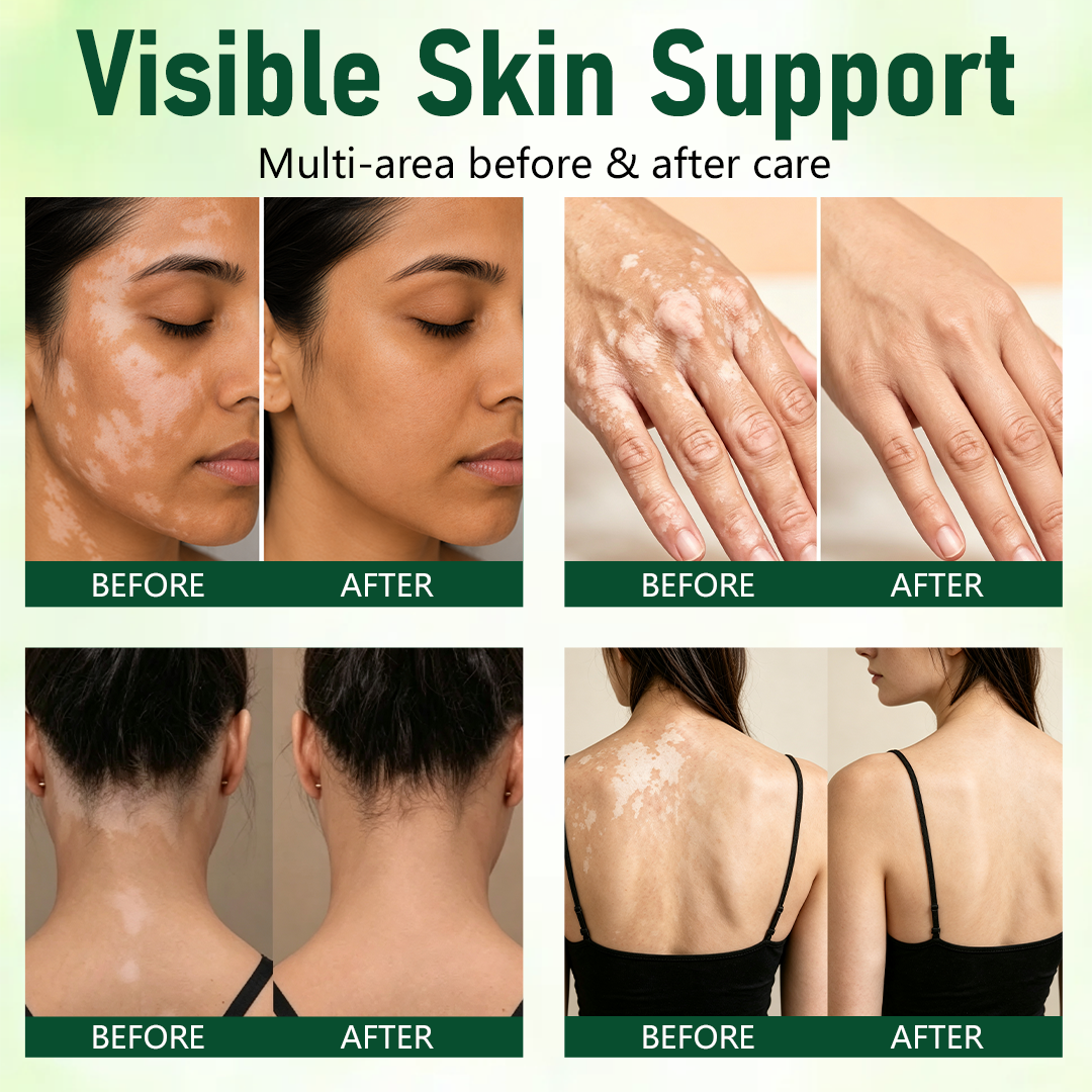 Rolimey® Herbal Vitiligo Cream