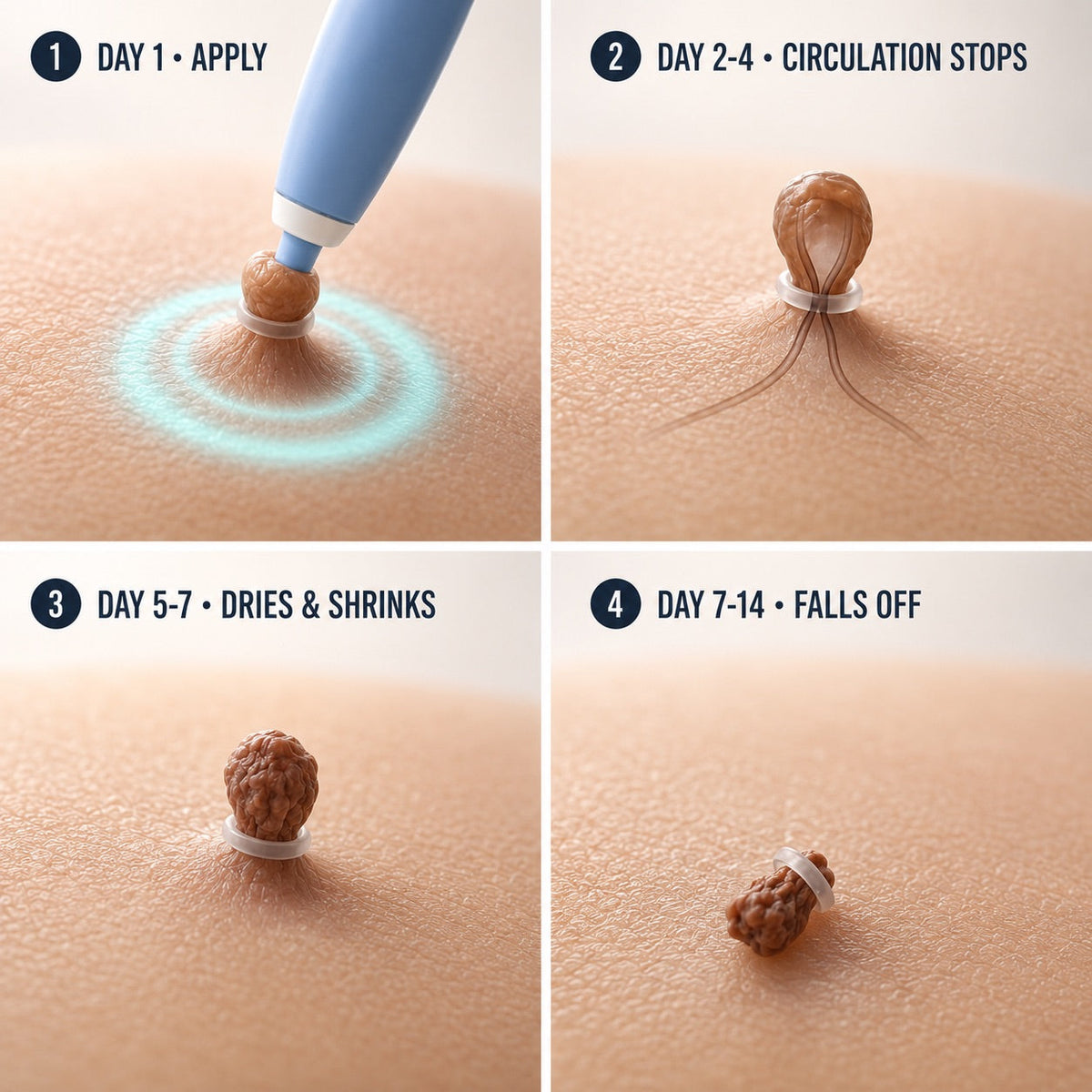 🗽GFOUK®Skintag Removal Kit