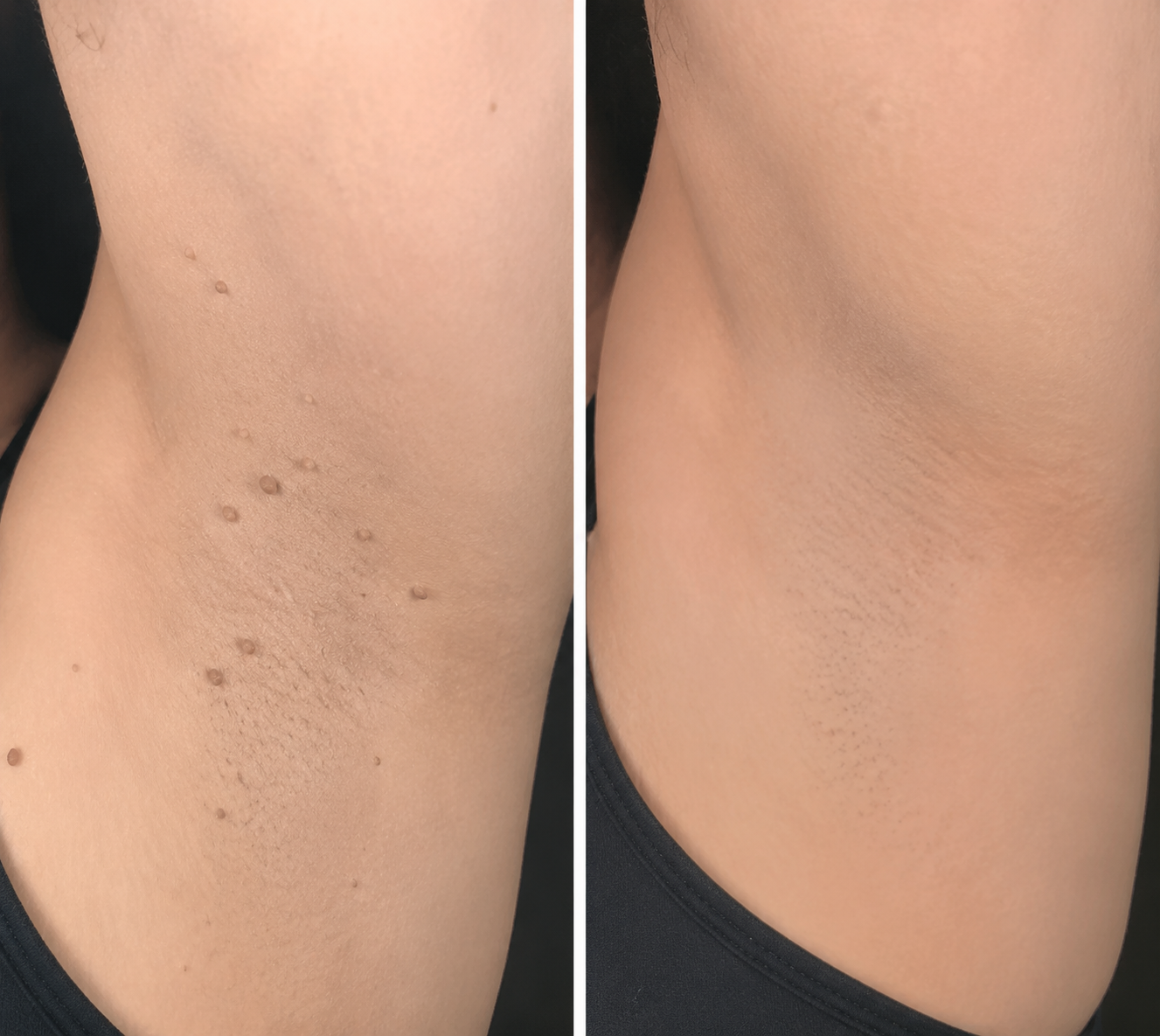 🗽GFOUK® 2-in-1 Microneedle & Hydrocolloid Skin Care Patches