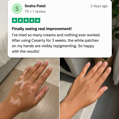 Rolimey® Herbal Vitiligo Cream